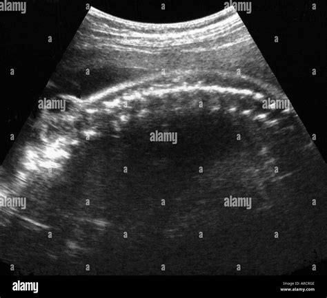 Spina Bifida Occulta Ultrasound