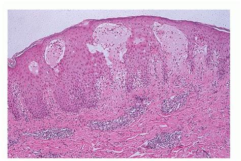Pemphigoid Gestationis الفقاعاني الحملي