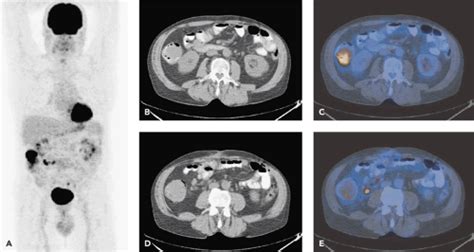 Pet Ct And Spect Ct Of Malignant Melanoma Radiology Key