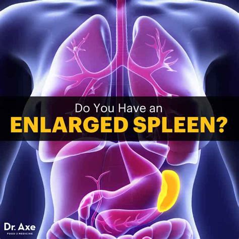Enlarged Spleen Symptoms Warning Signs 5 Treatments Dr Axe 2023