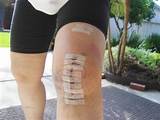 Side Incision Knee Replacement Surgery Photos