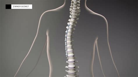 New Scoliosis Surgery Gives Hope To Retain Mobility