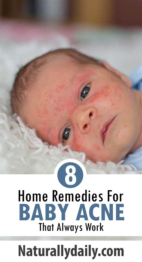 8 Best Home Remedies For Baby Acne That Always Work Baby Acne