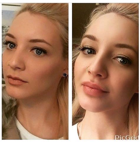 Another Gorgeous Before And After Photo Look At Them Lips 😍 Lip