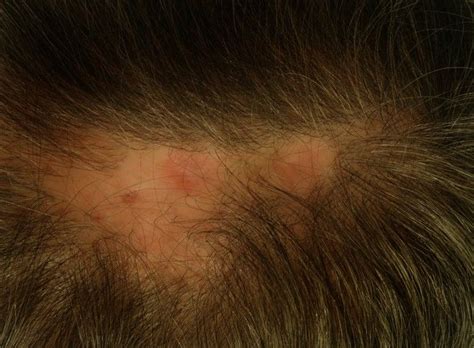 Sores On Scalp Pictures 5 Sores On Scalp Soreness Scalps