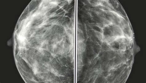 Mammogram Ultrasound Results