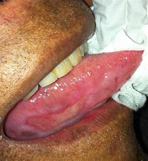 Mouth Cancer And Pre Malignant Conditions Mr Luke Cascarini