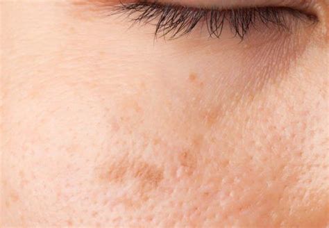 Enlarged Pores Treatments By Dermatologist Dr Gergana Gallacher