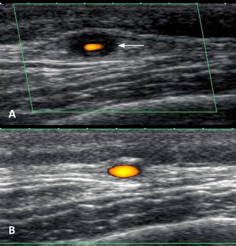 A Cross Sectional Doppler Ultrasound View Of The Right Temporal