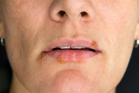 Neue Therapien Herpes Mit K Rpereigenem Protein Behandelbar Heilpraxis