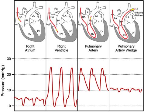 Pulmonary Capillary Wedge Pressure And Pulmonary Artery Wedge Pressure