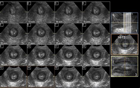 Transperineal Three Dimensional Ultrasound Imaging For Detection Of