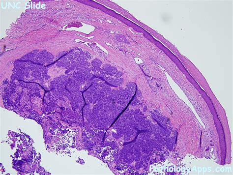 Merkel Cell Carcinoma Pathology