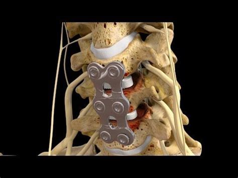 This video has been updated on april 2021.you can watch and free download cara masak ketupat 5 30 7 video. C5-6/C6-7 Anterior Cervical Discectomy with Fusion ...
