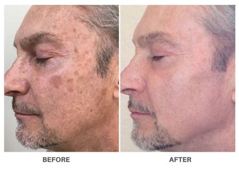 Laser Skin Resurfacing For Younger Healthier Skin