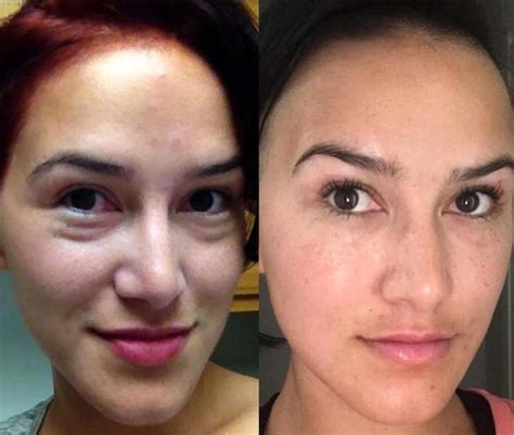 Arriba 102 Foto Botox For Eyes Before And After Actualizar