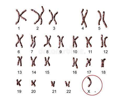 Trisomy 21 Karyotype
