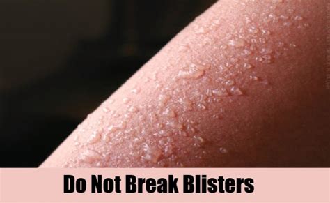 Ten Fast Ways To Treat Your Sunburn Blisters Effectively Yummylooks