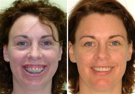 Case 21 Upper And Lower Jaw Surgery Sydney Oral And Facial Surgery