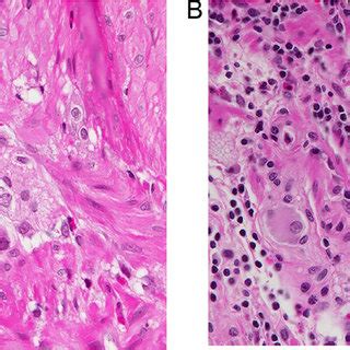 Parasympathetic ganglion cells found in connective tissue between muscle layers in esophagus, jejunum, and ileum; (PDF) Proposal of a rating scale to recognize Fabry ...