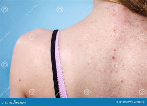 Woman With Skin Problem Acne On Back Stock Image Image Of Allergy