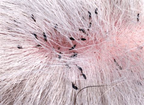 The Causes Of Head Lice