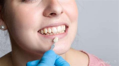 Veneer gigi adalah lapisan buatan yang dipakai untuk melapisi bagian depan gigi manusia. Veneer Putihkan Gigi Secara Instan, Lakukan 4 Tips Ini ...