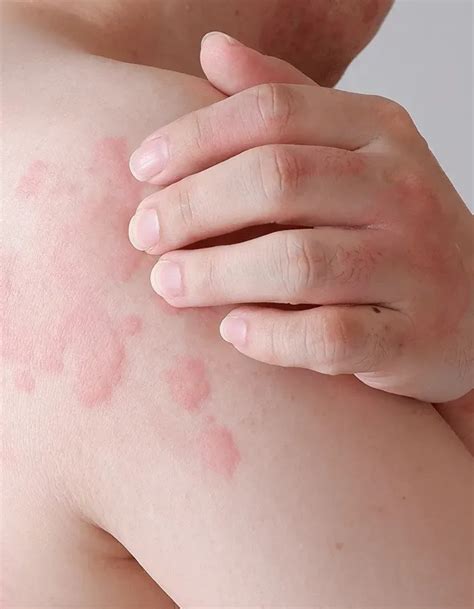 Hives For Tampa And Brandon Fl Allergy Asthma And Immunology