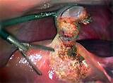 Laparoscopic Liver Cyst Surgery Recovery Pictures