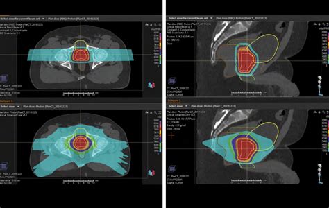 Proton Therapy Faqs For Lung Cancer Johns Hopkins Medicine
