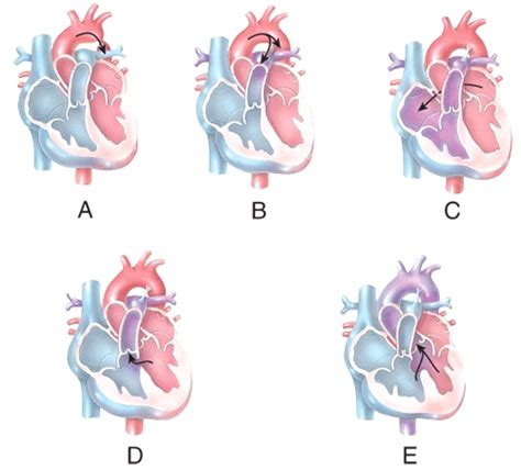 Which Of The Labeled Diagrams Shows An Atrial Septal Defect Biology