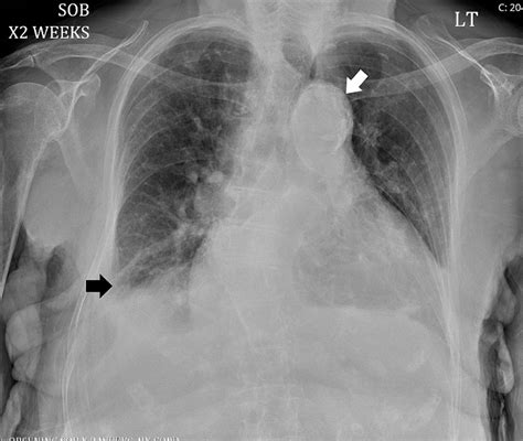 Cureus A Case Of Chronic Aortic Dissection With Hemopericardium And