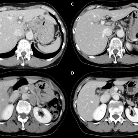 Radiological Findings Of Abdominal Ct Showed Enlarged Para Aortic Lymph