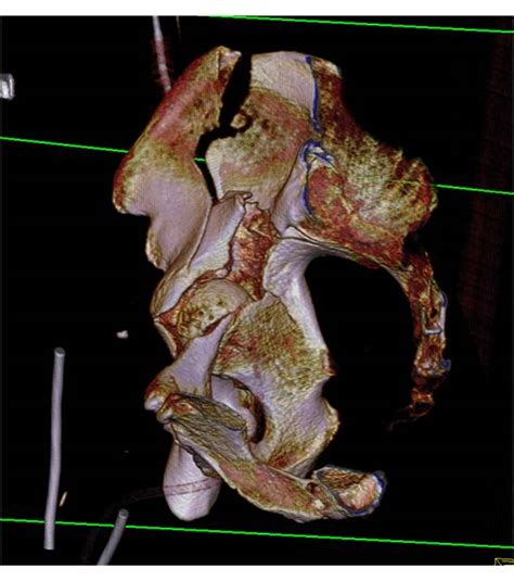 Iliac Wing Fracture Extend Into The Acetabulum - Trauma ...