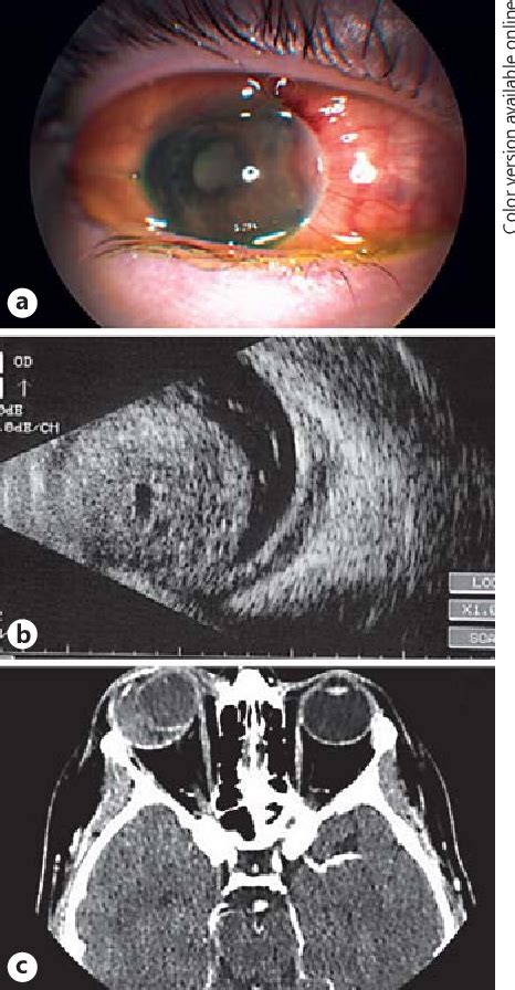 Figure 1 From Acute Presentation Of Mesectodermal Leiomyoma Of The