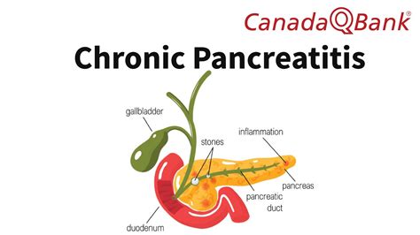 Chronic Pancreatitis Youtube