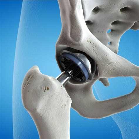 Hip Surgery Austin Tx Orthopaedic Specialists Of Austin