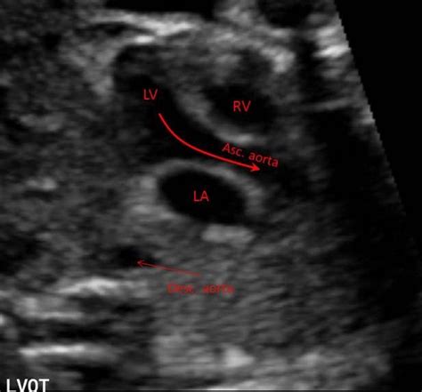 Resultado De Imagen De Fetal Heart Outflow Tracts Ultrasound