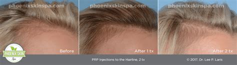 It's good to know the benefits and risks of any given hair loss treatment. Platelet Rich Plasma for Hair Loss - Phoenix Skin Spa