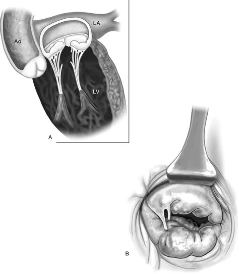 Simplified Mitral Valve Repair In Pediatric Patients With Connective