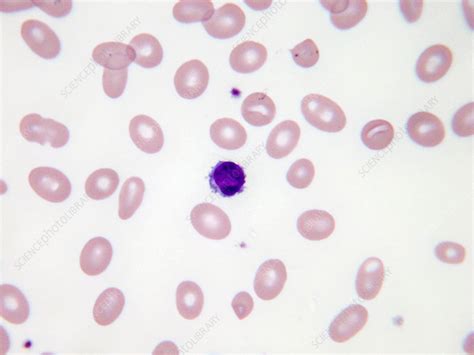 Macrocytic Anaemia Lm Stock Image C0435225 Science Photo Library