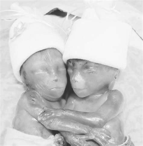 Mother Shares Powerful Photos Of Identical Twins Miscarried At 19 Weeks