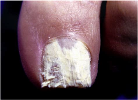 Emerging Systemic Fungal Infections Clinics In Dermatology