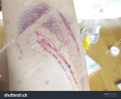 Closeup Bruise Scraped Wound Leg Injury Stock Photo 1303589824