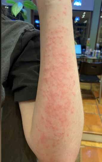 ‘allergic To Cold Temperatures One Girls Story Of Cold Urticaria