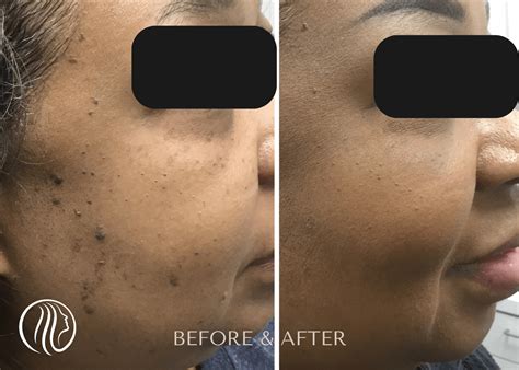 Dermatosis Papulosa Nigra Understanding And Treating This Common Skin