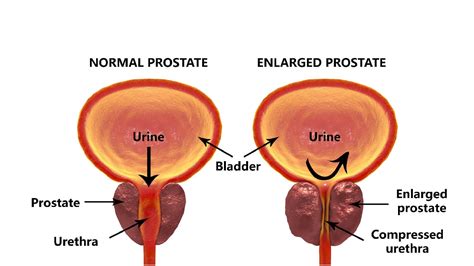Prostate cancer starts in the prostate, a gland located below the bladder and in front of the rectum. Prostate Cancer in Men | Prostate Cancer Cases, Symptoms ...