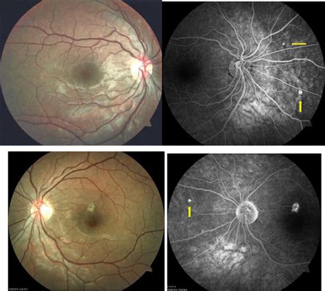 July 2015 Retinography And Fluorescein Angiography Normal Appearance