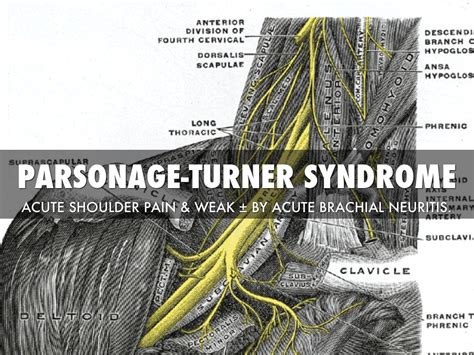 Parsonage Turner Syndrome Jonathan Aarons Md Pain Management