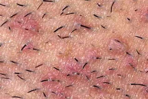This is termed as an ingrown hair, as the name suggests, the hair that has grown inwards, back into the skin. Ingrown Pubic Hair, Cyst, Hard Lump, Infected, Male ...